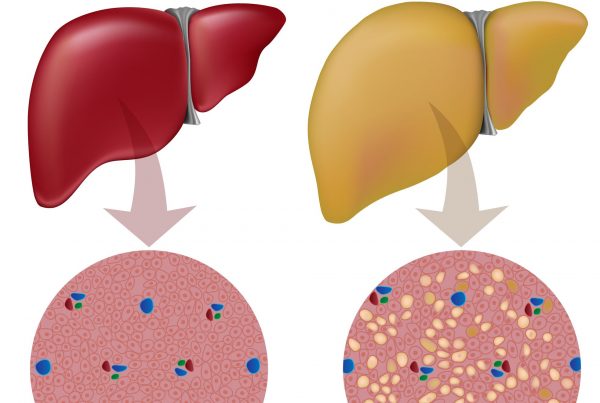 17754258 fatty liver disease